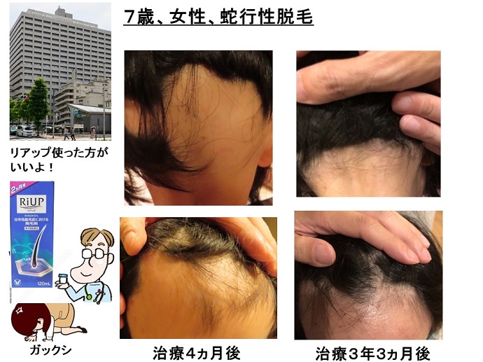 円形脱毛症　病院